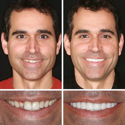 Ends Today: 50% OFF! ⏰ KLENIMORE™ Custom-Fit Smile Support Set — Strong Hold & Natural Look 🦷