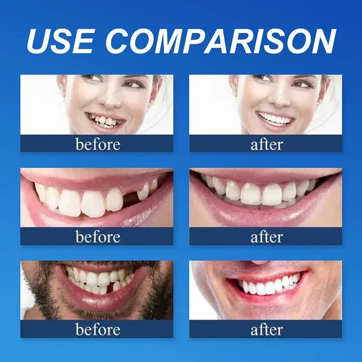 Ends Today: 50% OFF! ⏰ KLENIMORE™ Custom-Fit Smile Support Set — Strong Hold & Natural Look 🦷