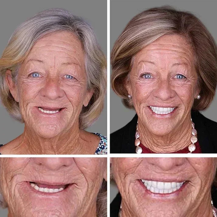 Ends Today: 50% OFF! ⏰ KLENIMORE™ Custom-Fit Smile Support Set — Strong Hold & Natural Look 🦷