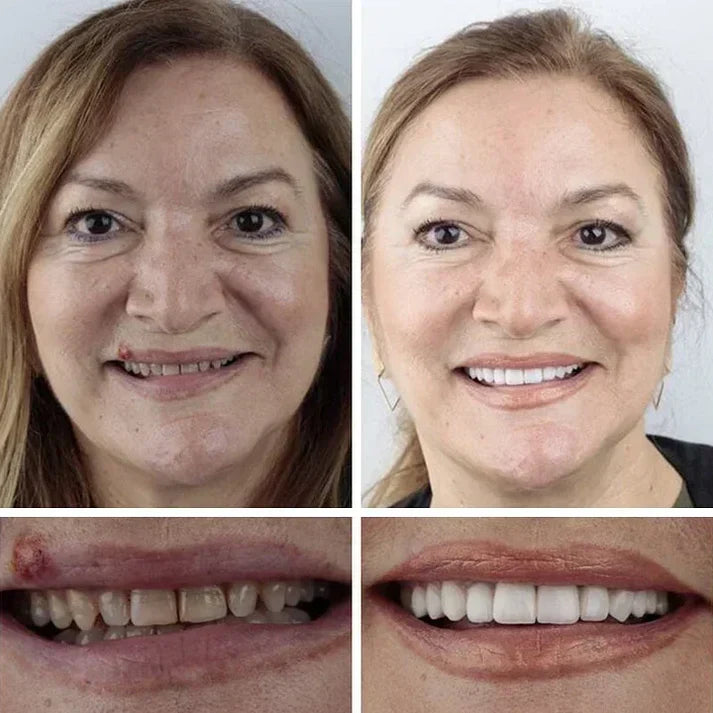 Ends Today: 50% OFF! ⏰ KLENIMORE™ Custom-Fit Smile Support Set — Strong Hold & Natural Look 🦷