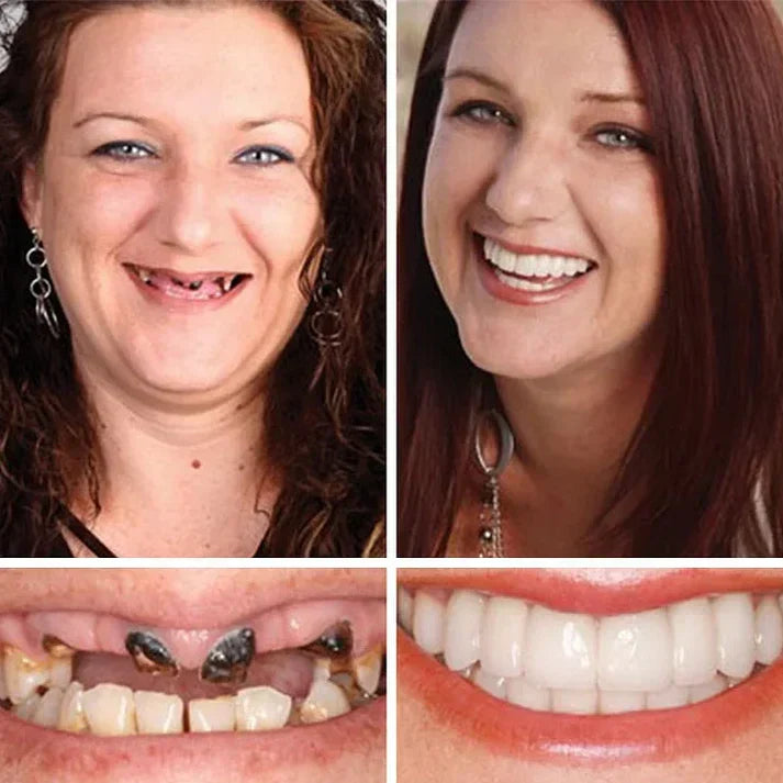 Ends Today: 50% OFF! ⏰ KLENIMORE™ Custom-Fit Smile Support Set — Strong Hold & Natural Look 🦷